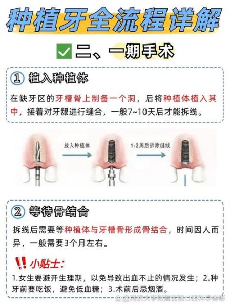 种牙流程?种牙流程需要多久?