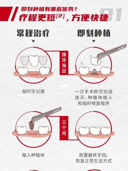 种牙流程?种牙流程需要多久?