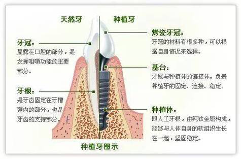 种植牙能不能用一辈子?种植牙能不能用一辈子呢?